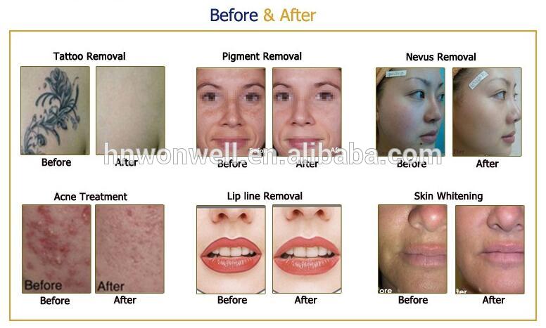 Q switched nd yag laser