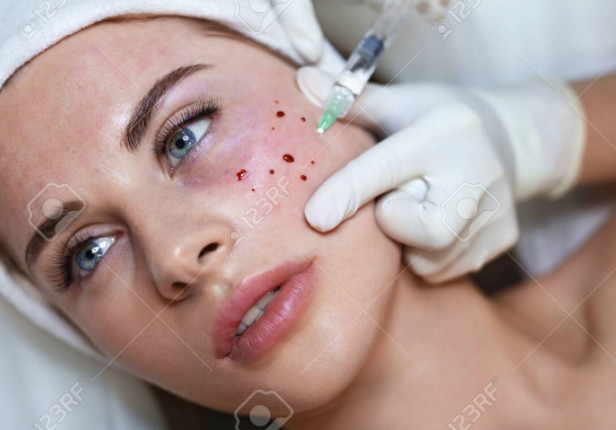 relieve wrinkle Youth Serum Injection 24mg/ml Mesotherapy Face Collagen Injection