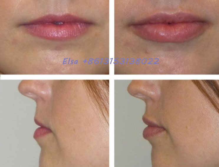 24mg/Ml DermalJuvederm Lip Filler Voluma Ultra3