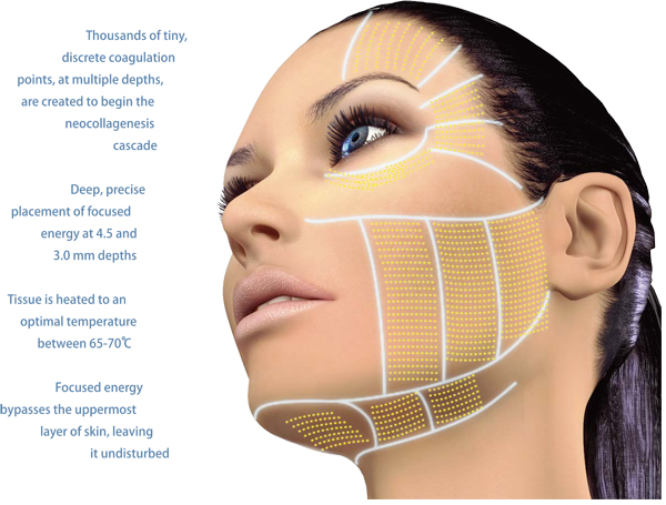 HIFU Face Lift Machine Types Of Heads 1.5mm / 3.0mm / 4.5mm Screen Size 15 Inch 300W Power