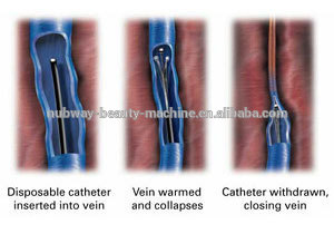 Varicose-Vein-Removal-2
