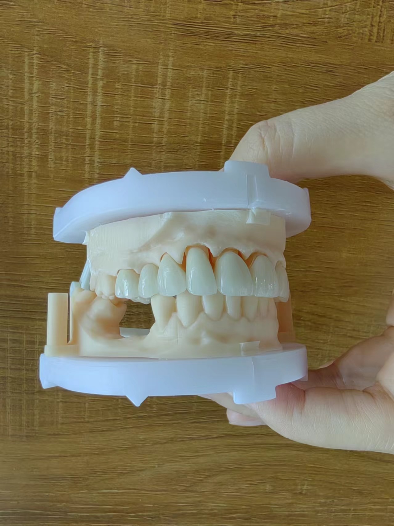 Layered Zirconia Bridge For Fixed Restoration Beautiful Smiles Professional Stable