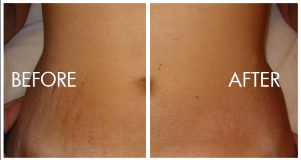 Fractional Co2 Laser Skin Resurfacing Machine For Stretch Marks Elimination