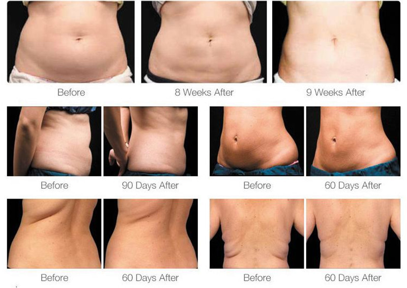 RF Fat Freeze Slimming Machine 360 Skin Tightening Cryolipolysis Equipment