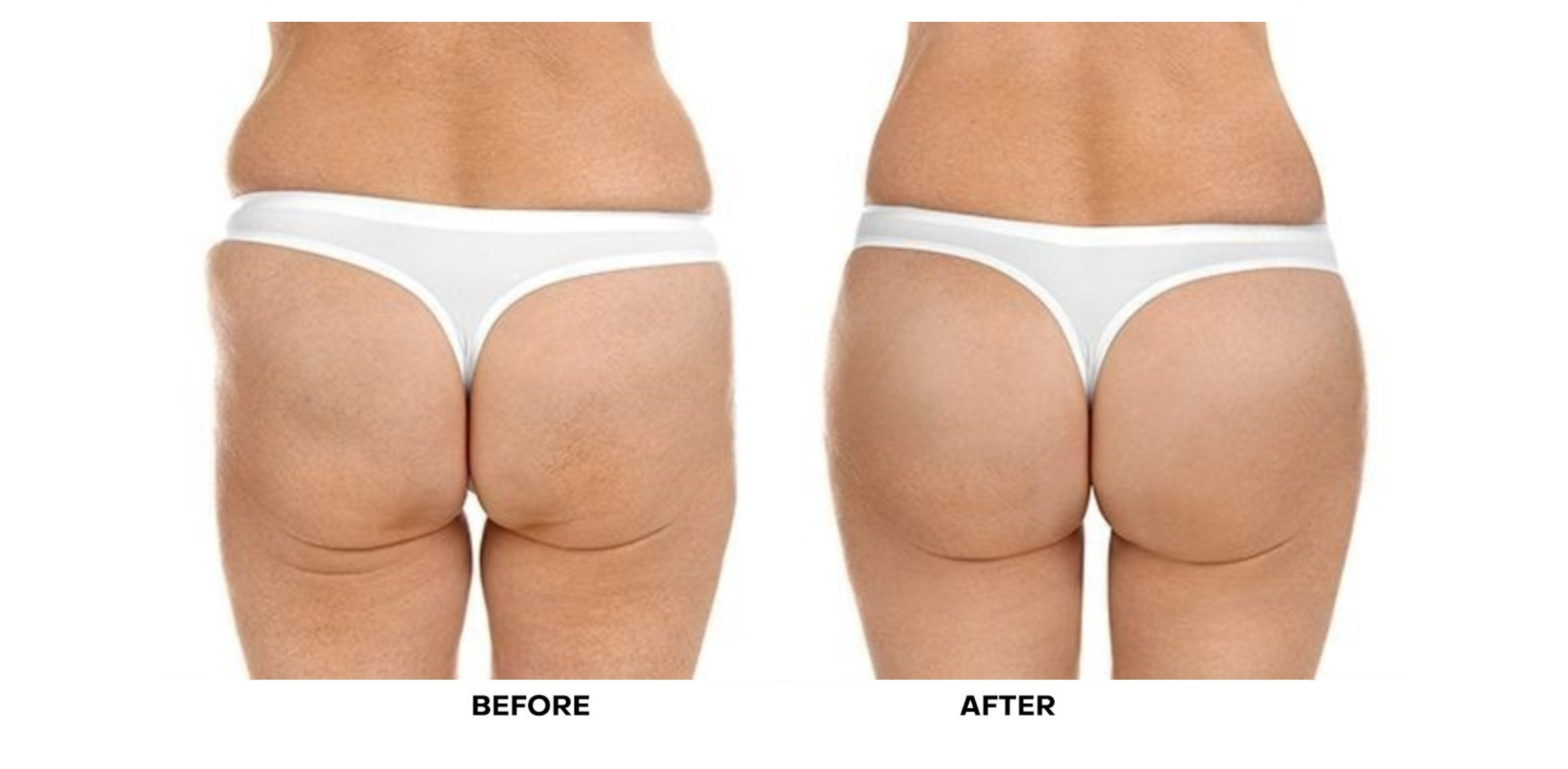 Hyaluronic Acid Breast Dermal Filler Breast Augmentation Buttock Lift Injection
