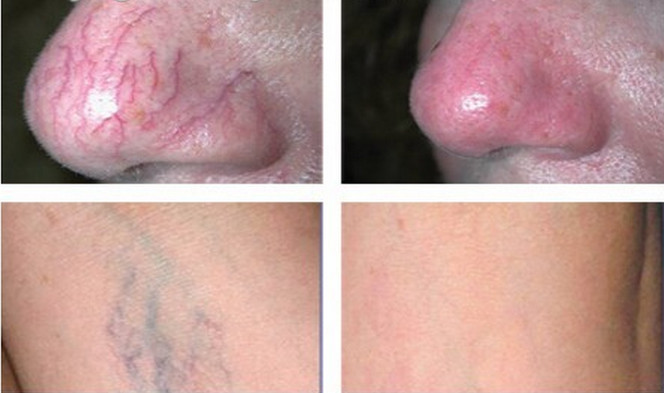 15W 30W 60W 980nm Laser Pigmentation Removal Machine AC100-240V