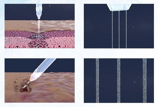 Jetpeel Facual Pressure Injecting Hydro Skin Oxgyen Injection Machine For Sale Myjet Jetpro Jet Peelingg Glowing skin