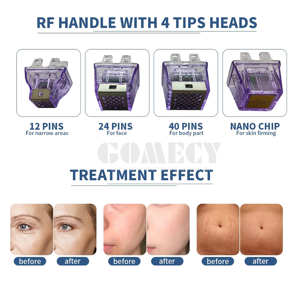 Portable 3 In 1 Morpheus8 RF Fractional Machine For Rf Microneedling Handle Replacement Scar Removal