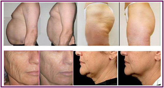 Multi Frequencies RF Skin Tightening Machine Non Invasive 50hz
