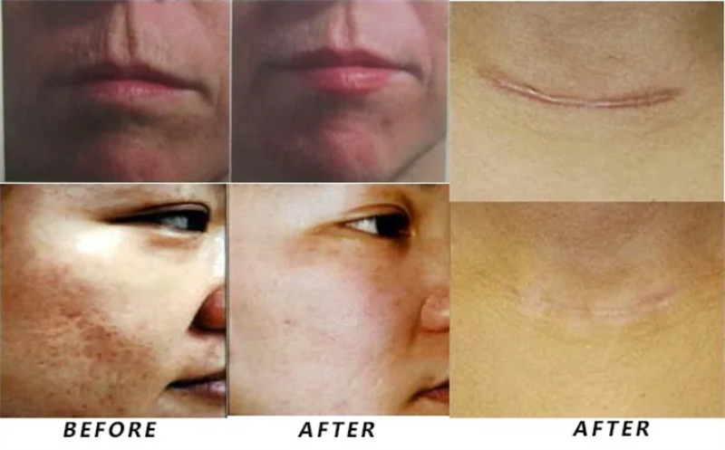 Desktop Fractional Laser Machine Scar Removal Body Skin Tightening