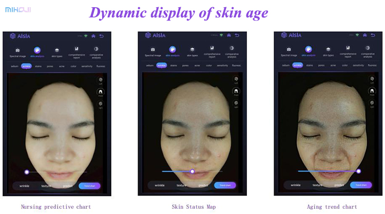 Effective Acne Treatment with Q1 Q2 Skin Analysis Machine and Pigmentation Analysis