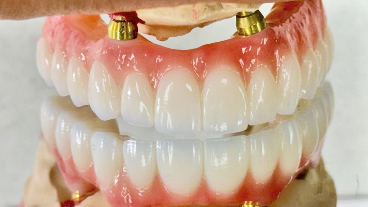 Dental All On X Implant PFM Crown Titanium Fixed Hybrid Denture