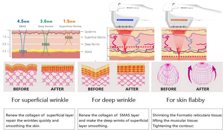 HIFU Face Lift Machine Types Of Heads 1.5mm / 3.0mm / 4.5mm Screen Size 15 Inch 300W Power