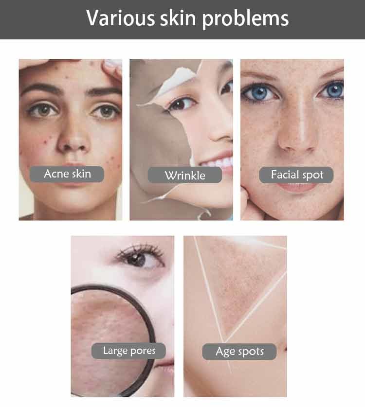 150Hz Jett Plasma Skin Rejuvenation Machine For Face Lifting Wrinkles Freckle Removal