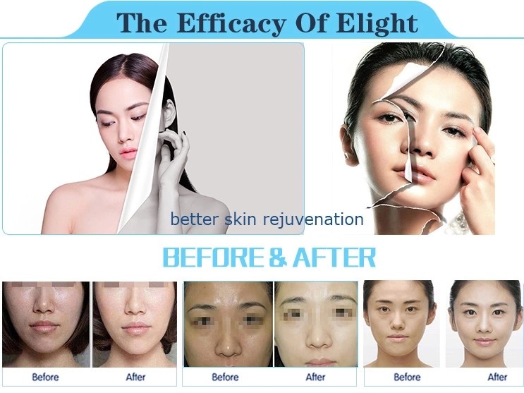 2018 multi-function big spot high energy best cooling system ipl elos shr ipl hair removal machine