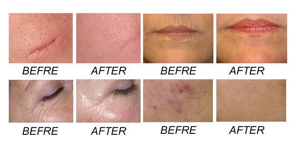 RF tube Fractional CO2 Laser Vaginal Tightening And Rejuvenation Machine