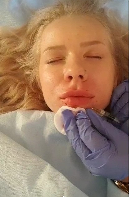 Clinic Injectable Dermal Filler , Transparent Hyaluronic Acid Injection
