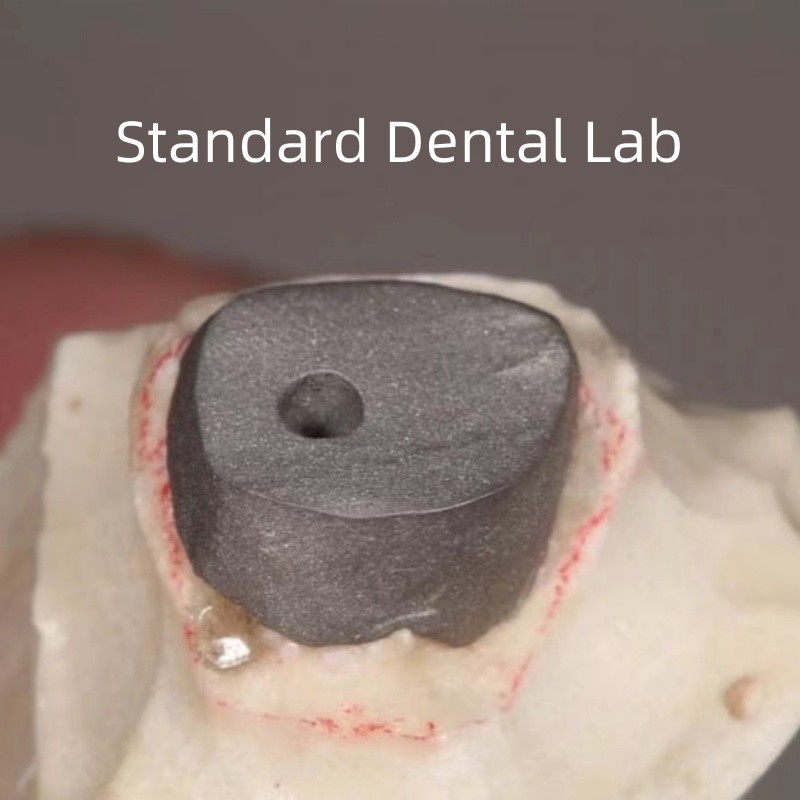 Dental Restoration Metal Post And Core Crown Perfect Fit