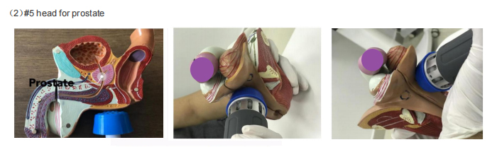 Body Pain Extracorporeal Shockwave Therapy Machine For ED Erectile Dysfunction