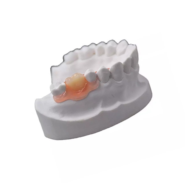 Comfortable Beautiful PFM Temporary Dental Crown Wholesale High Chewing Efficiency
