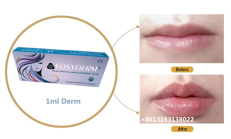 1 Ml Cross Linked HA Dermal Filler Gel Injection Lip Fillers 24 Mg/Ml