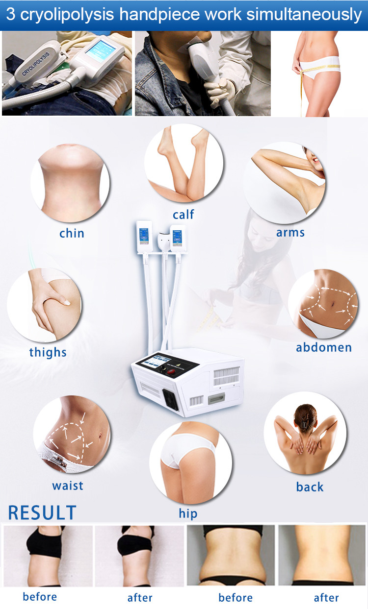 Best 360 Fat Freezing Cryolipolisis Slimming Machine For Salon Personal Care