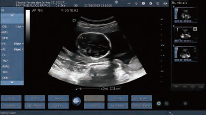 Mobile Phone Probe Wireless Ultrasound Probe Convex Linear Transvaginal Micro-convex Changeable Probe