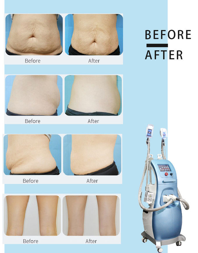 6 in 1 Salon use Multifunction weight loss cavitation rf vacuum cryo lipo laser slimming beauty machine LF-208