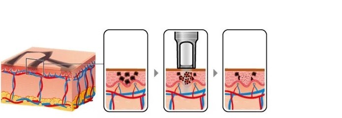 4h Diode Laser Hair Removal Equipment Design Oem Odm