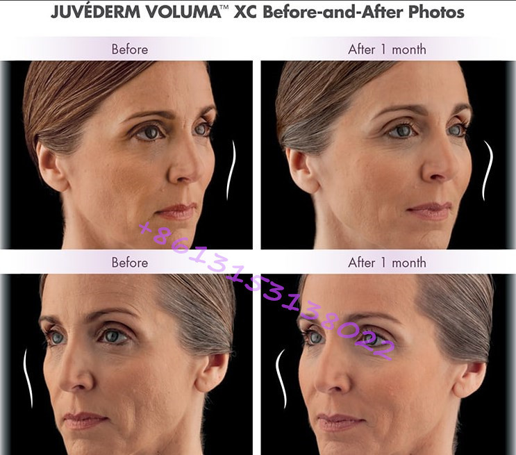 Juvederm Hyaluronic Acid Dermal Filler Juvederm Ultra Voluma 2×1ml