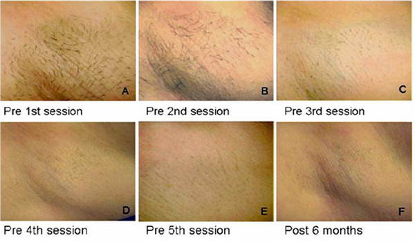 808nm diode laser facial hair removal for women/laser body hair removal/permanent hair removal