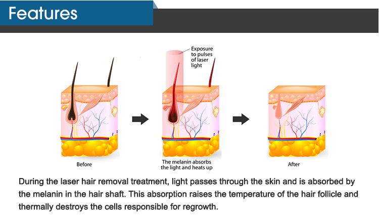 LCD 755nm+808nm+1064nm Diode Laser Hair Removal Machine With Medical CE