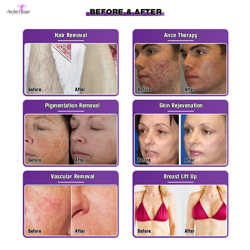 Painless Permanent Hair Removal Machine 2500W OPT IPL Skin Treatment Machine