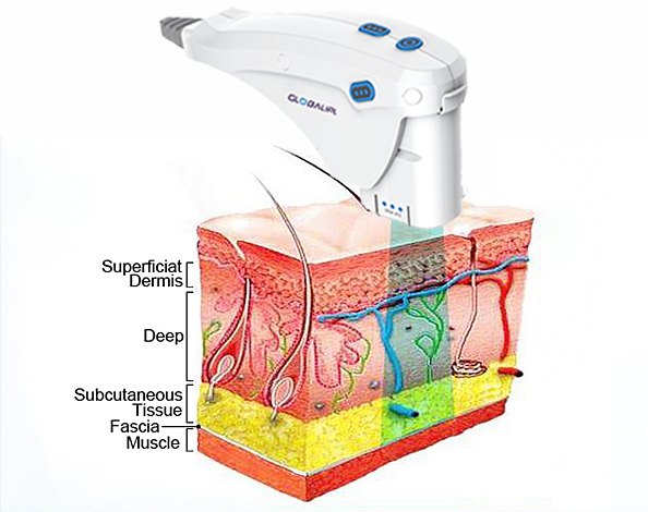 Face Lifting Stretch Mark Removal hifu face lift machine