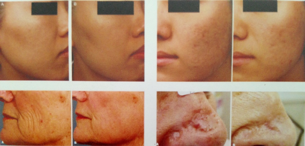 RF drive metal tube fractional co2 laser resurfacing/fractional laser stretch mark removal/laser wrinkle removal