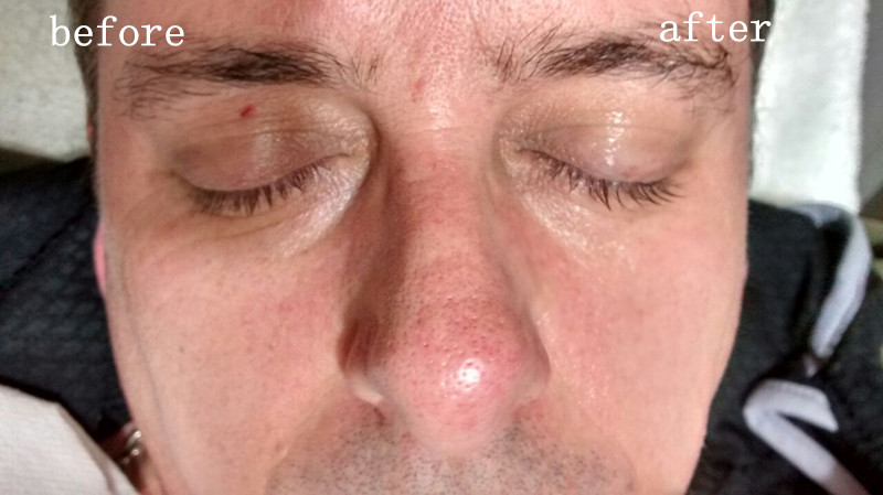 Skin Rejuvenation Machine Face Wrinkle Removal Machine Jowl lifting