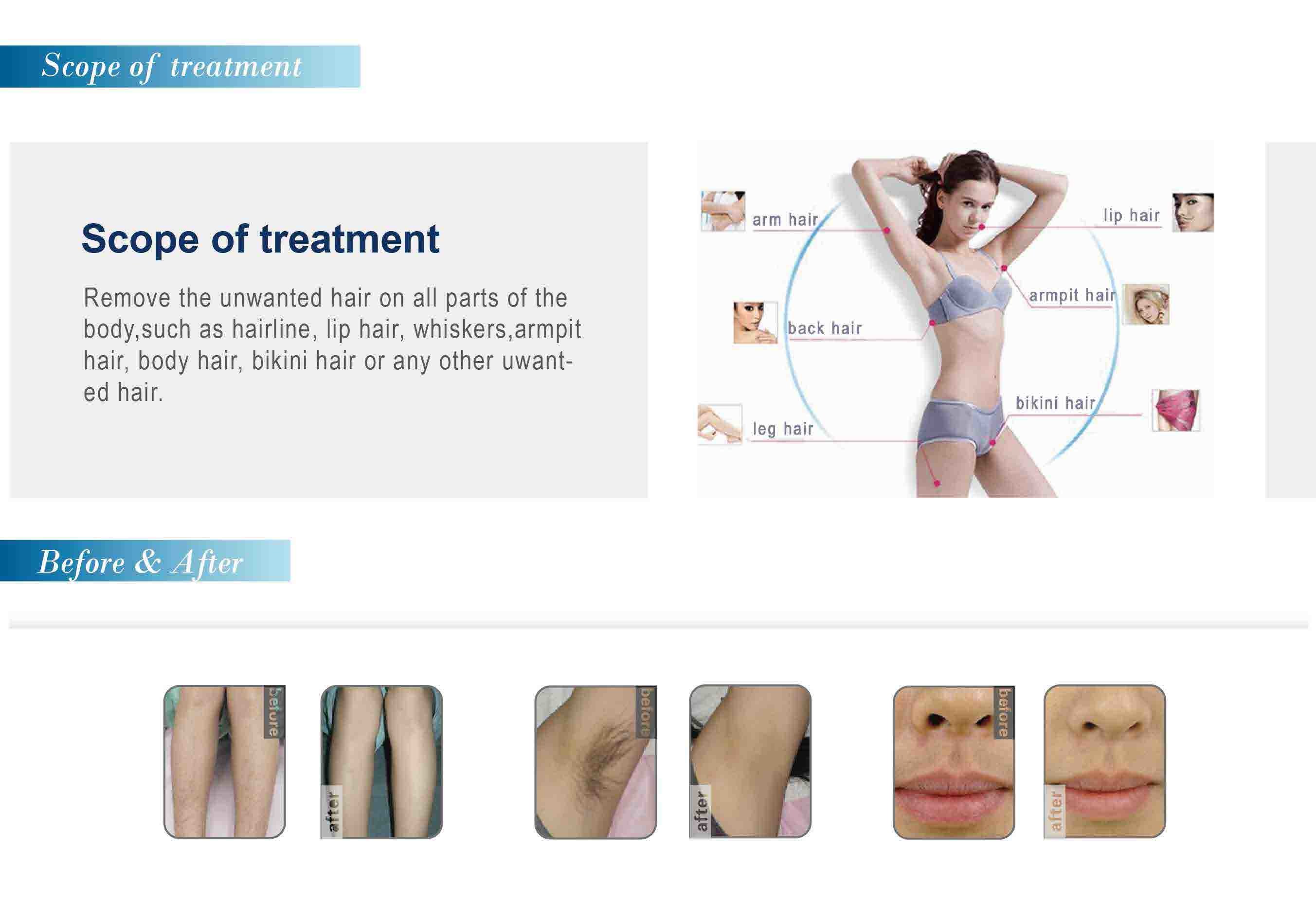808 diode laser hair removal machine FDA approved laser hair removal machine