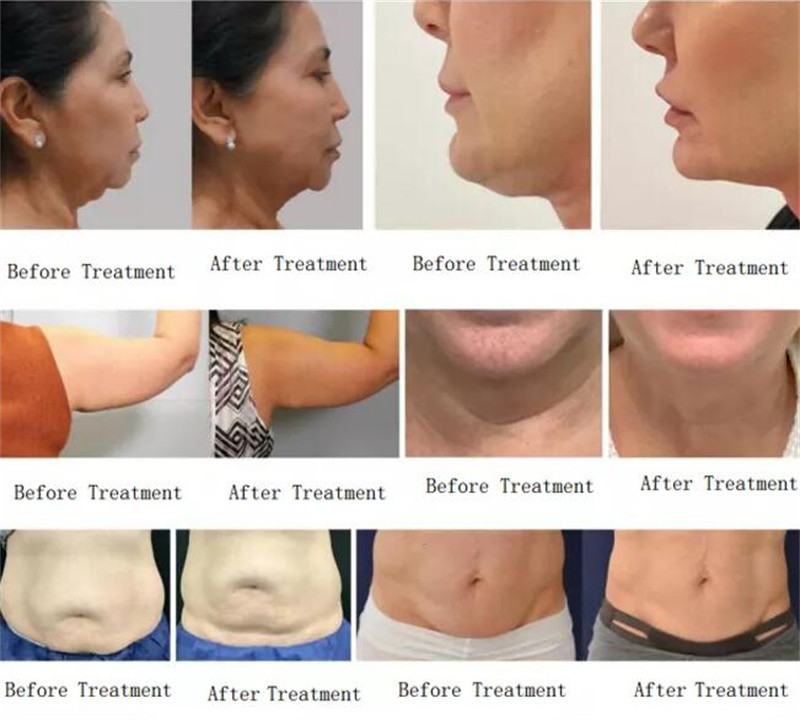 100w Radio Frequency Beauty Device 2mhz Monopolar Trusculpting Cellulite Treatment