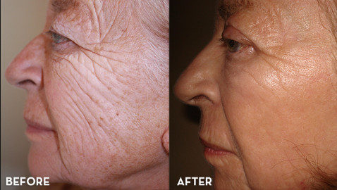 Skin Resurfacing CO2 Fractional Laser Machine For Epidermis Resurfacing / Wrinkle Reduction