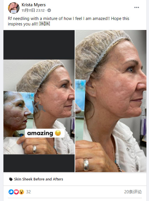 Microneedling Skin Tightening Radio Frequency Machine 2Mhz Therapeutic Medical Equipment