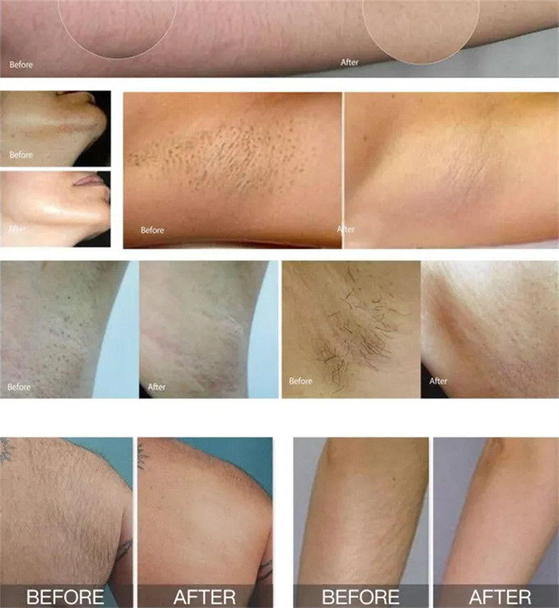 808 Nm Yag Laser Diode Hair Removal Machine 500w 1600w For Face And Body