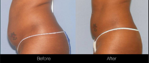 Shaping Body Surgical Liposuction Machine Lipo Slim Machine For Chin / Outer Thighs