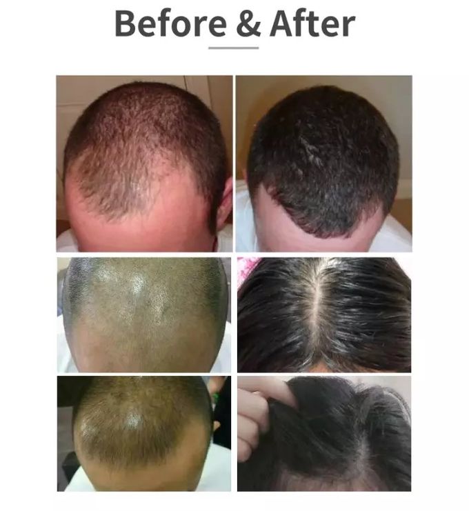 ISO Laser Hair Growth Helmet 8000B Kernel Medical Equipment