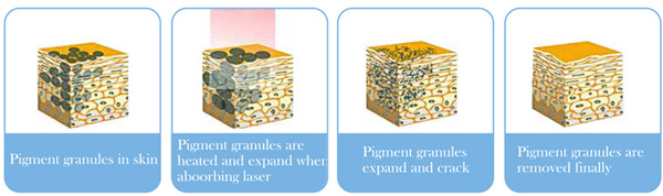 Price laser tattoo removal laser machine to remove freckles gentle yag laser