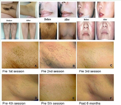 Before after pictures