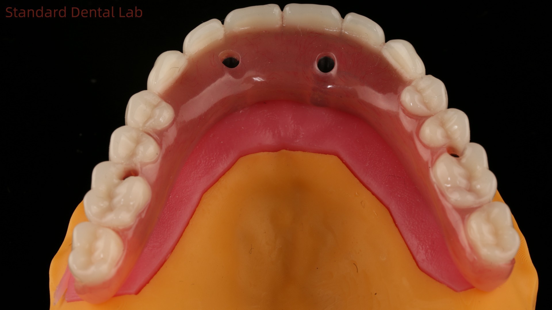 Acrylic Partial Implant Over Denture Titianium Bar Full Denture Teeth Set Up Screw Retained