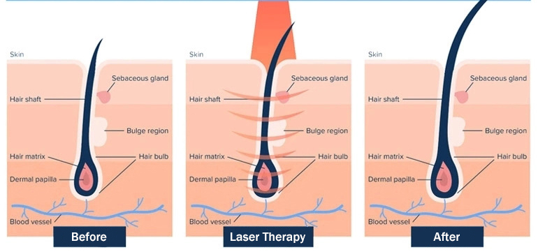 Infrared Hair Regrowth Laser Machine , 650nm Diode Laser Hair Fall Treatment Machine