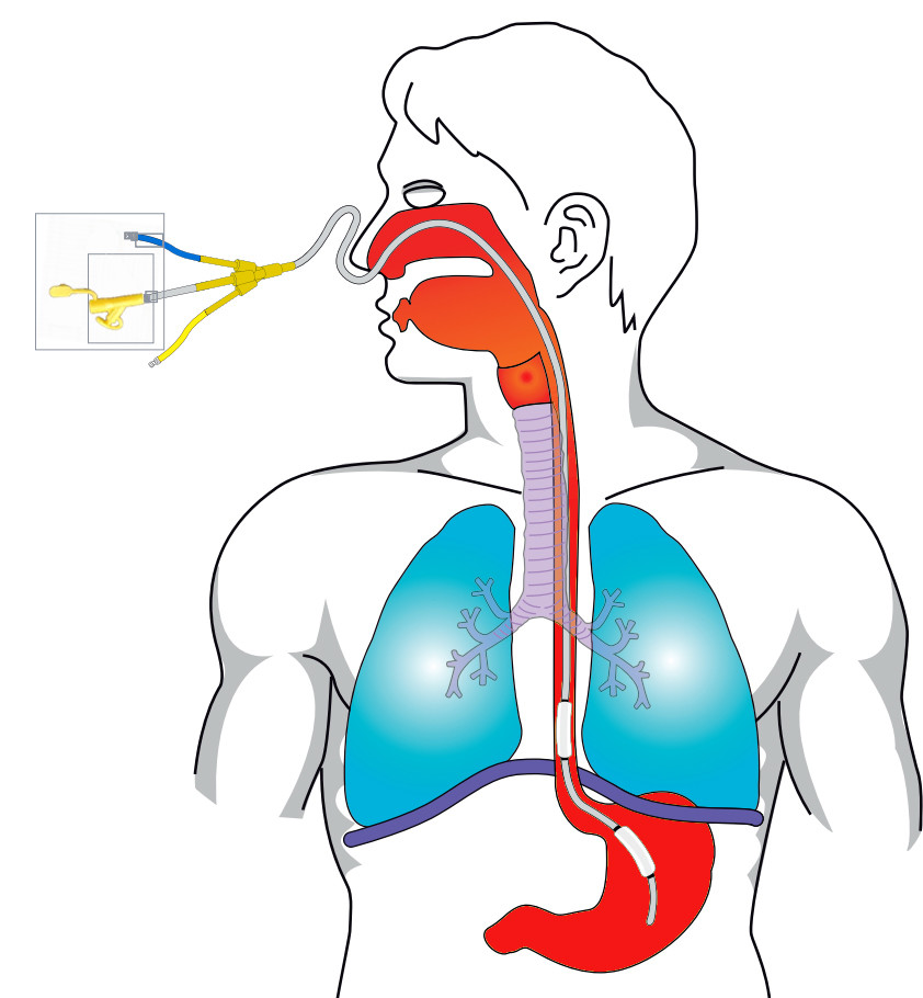 Enteral Feeding Tube with One/Two Balloons for Esophageal Pressure Measurement