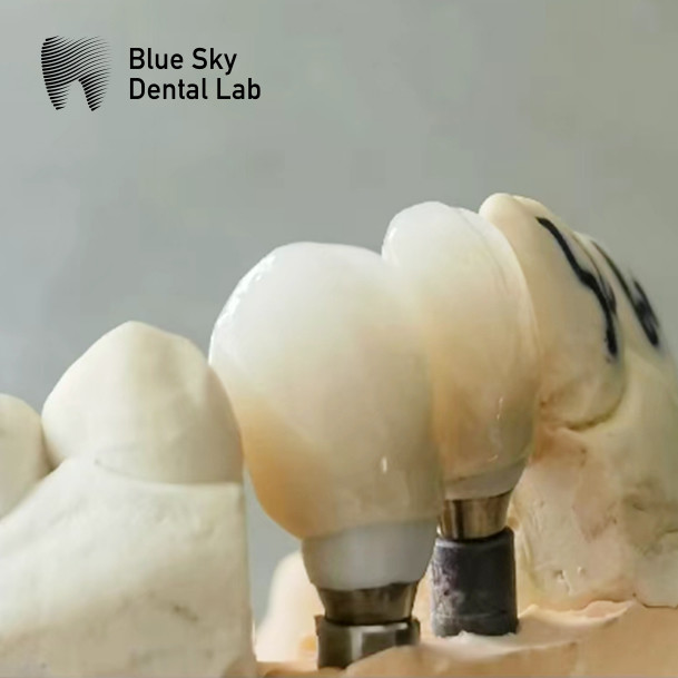 Precision Milled Zirconia Abutment With Single Implant Crown