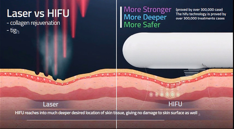 5 In 1 / 4 In 1 Hifu Lipo Slimming Machine 4D Ultra Sonic Hifu Therapy For Face Lift Tighten Skin Fat Loss Machine